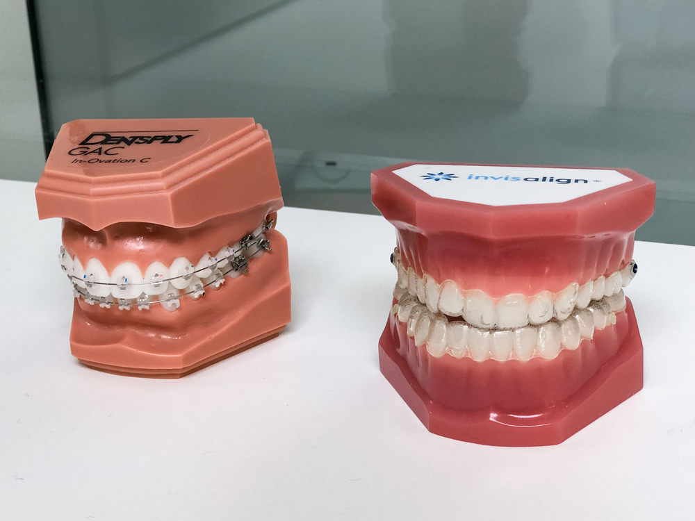 traitement invisalign et appareil dentaire