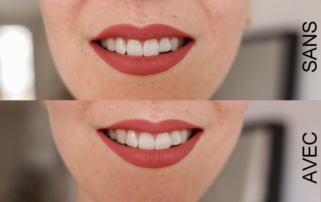 sourire et dentition avec et sans aligner invisalign